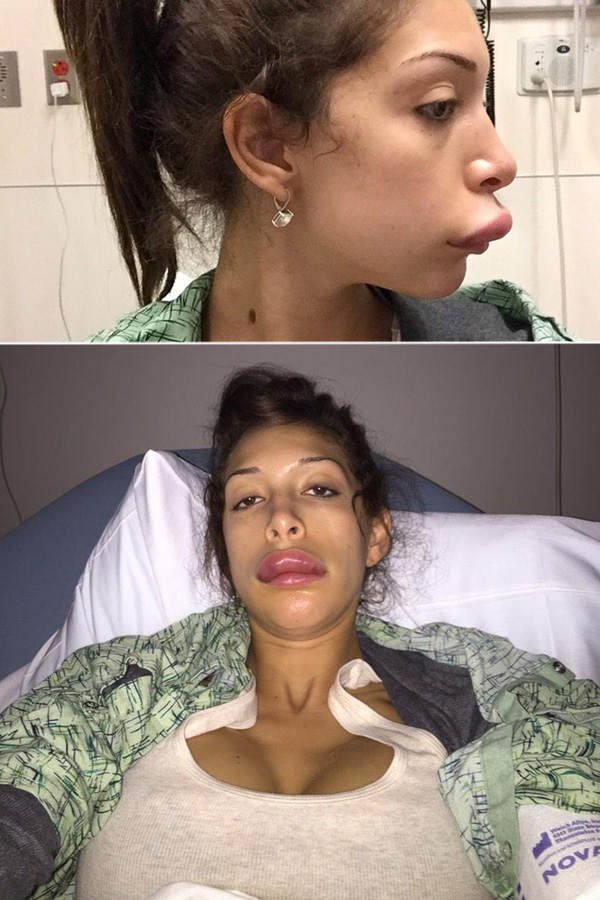 Farrah Abraham: Lippen-Implantate