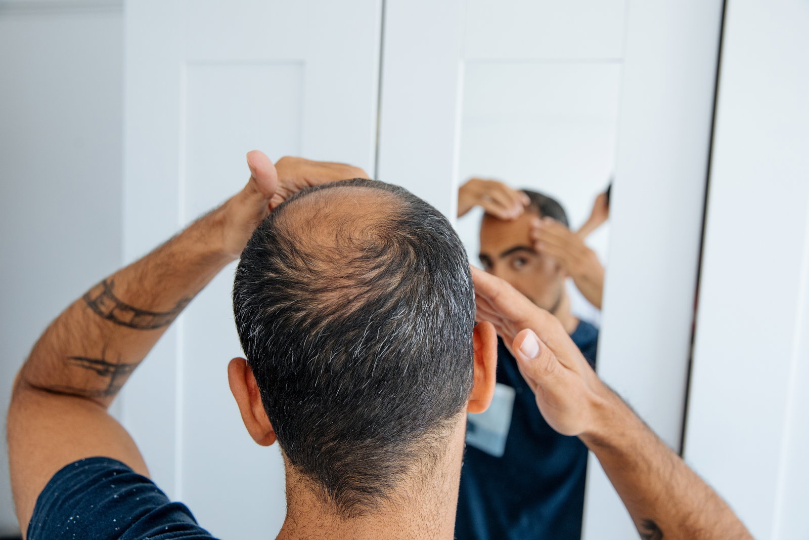 Haarausfall bei Männern: Die häufigsten Ursachen