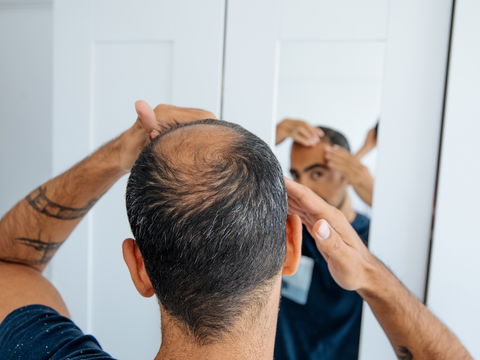 Der anlagebedingter Haarausfall