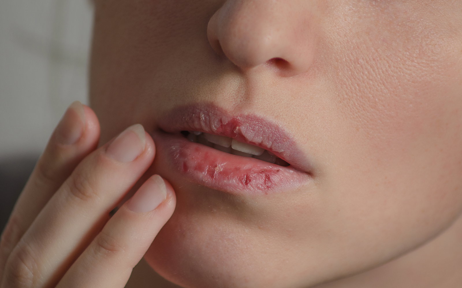 Aufgeplatzte Lippen: Die besten SOS-Tipps
