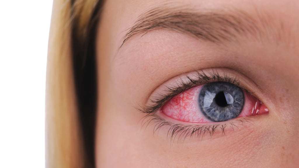 Rote Augen nach dem Schlafen: Normal oder Notfall?