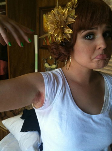 Twitpic Kelly Osbourne mit Ausschlag