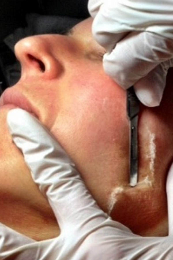 Dermaplaning