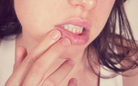 Tipps & Tricks bei Lippenherpes!