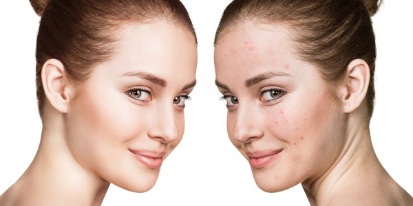 10 Make-up-Regeln für unreine Haut