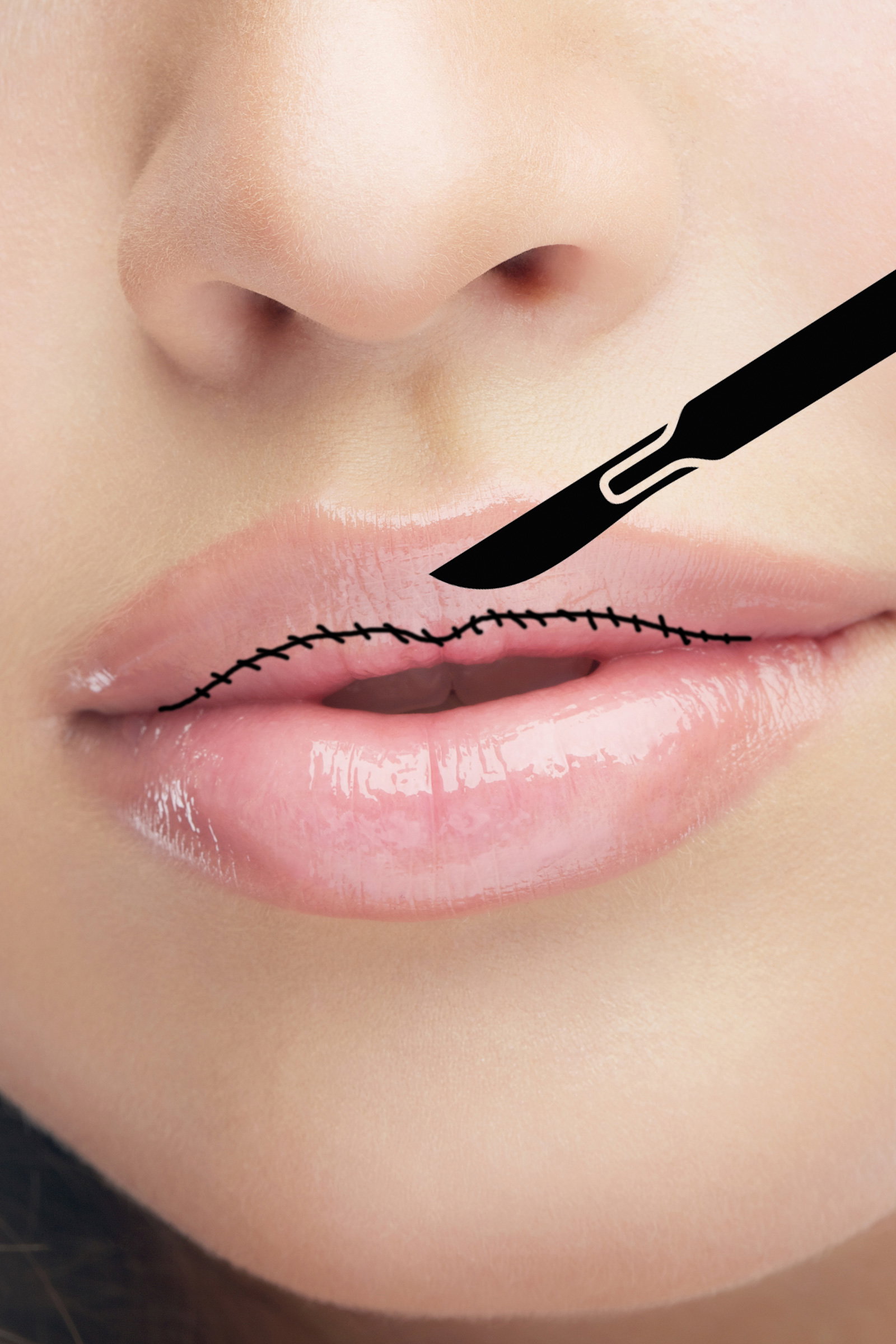 Lip Reduction: Der neue Trend aus Asien