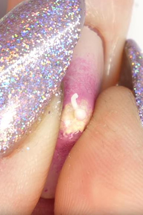 Pimple Nails