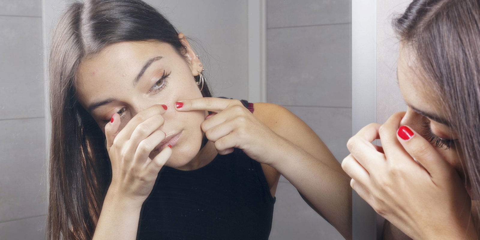 Periorale-dermatitis-quer